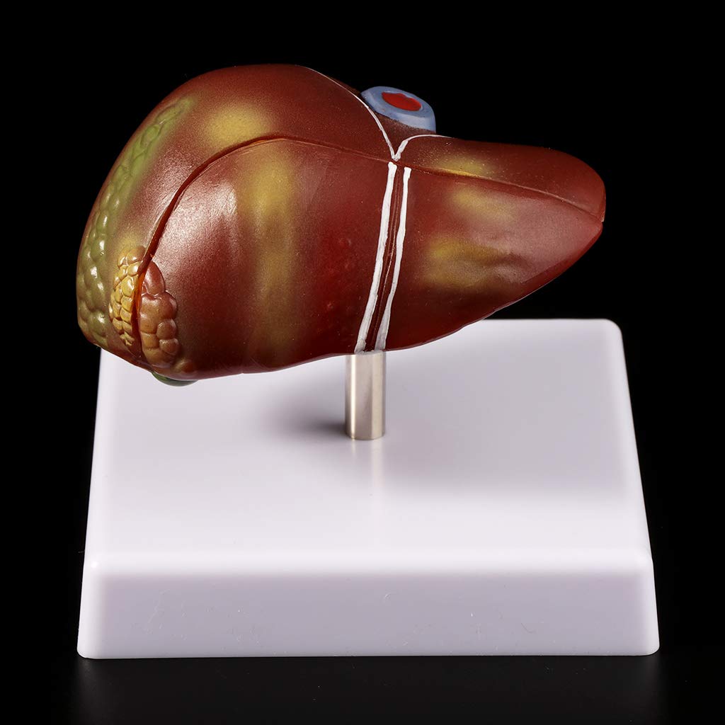 Modelo anatómico patológico del hígado humano, anatomía, escuela, enseñanza, displa