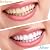 5 Sets Cosmetic Venners Dentures Teeth Veneers Fake Braces Snap on Your Smile Veneer Instant Perfect Smile Essential for Dating and Work 5 Upper and 5 Lower