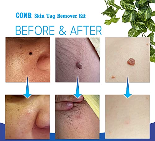 Image of Skin Tag Remover Kit (2-4mm) CONR Micro Painless DIY at Home with Cleansing Swabs Non Toxic Face Care Mole Wart Tool For Small To Medium Skin Tag (not for smaller than 2mm or flat skin tags)