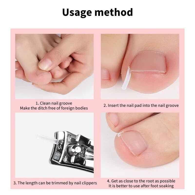 20Pcs Ingrown Toenail Correction Strips Brace Kit,Ingrown Toenail Corrector Straightener Strips Recover Clips Toenails Thick Pedicure Tool Toenail Straightener Strip