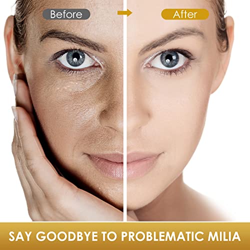 buying guides for best skin tag removal MiliaRemover MiliaTreatment