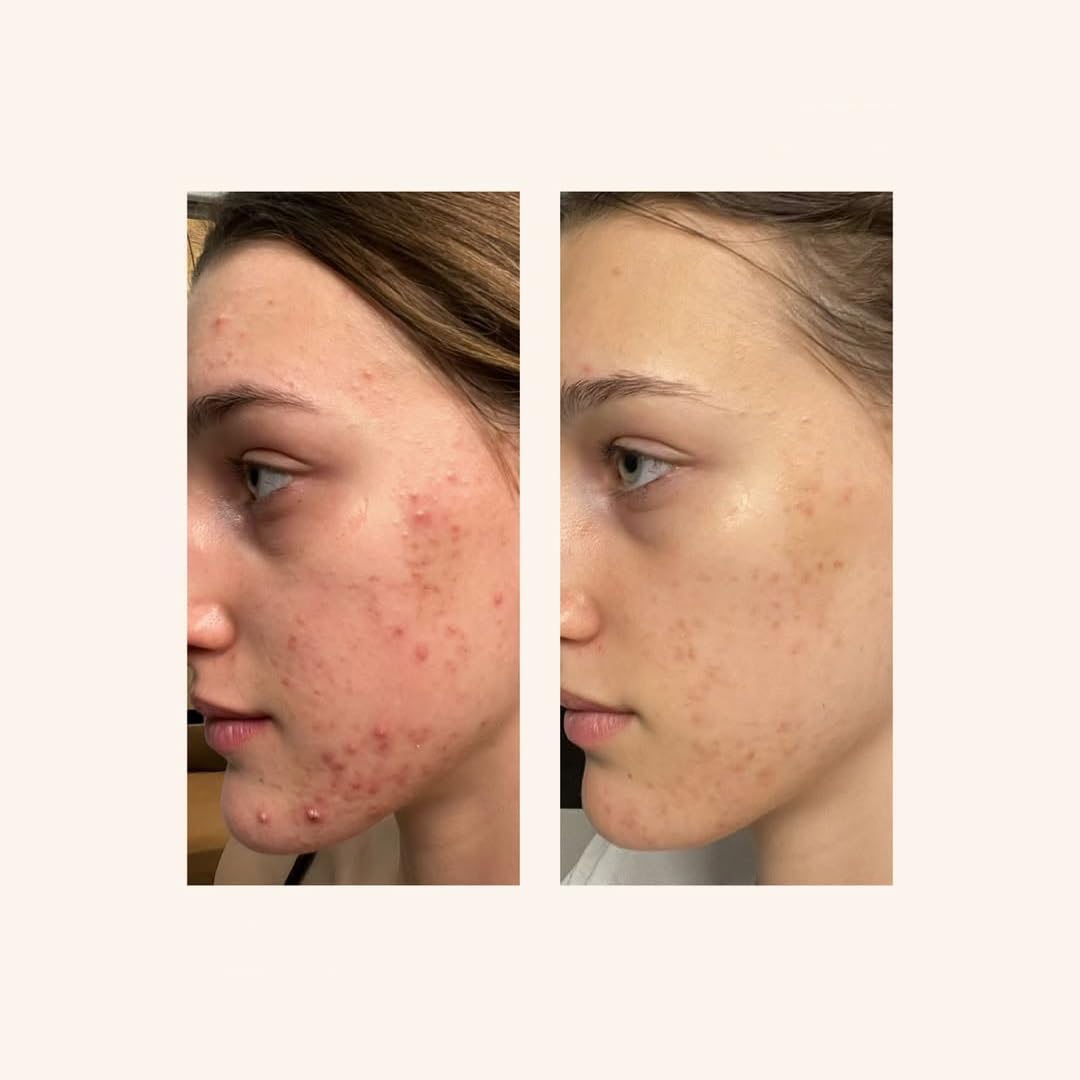 ALKEMY Crema Brufoli Viso, Trattamento anti Acne Dermatologicamente Testato, Riduce Brufoli, Imperfezioni, Rossori, Azione Purificante e Lenitiva per pelle a tendenza acneica, Cosmetica Naturale, 50ml