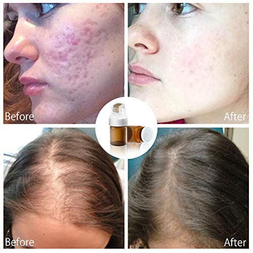 Koi-Beauty-Derma-Stamp-025mm-Titanium-Microneedling-Hydra-Needle-Roller-Anti-Aging-Help-Absorb-Import-Hair-Growth-Oil-Hyaluronic-AcidVitamin-C-EGF-PeptidesStem-Cell