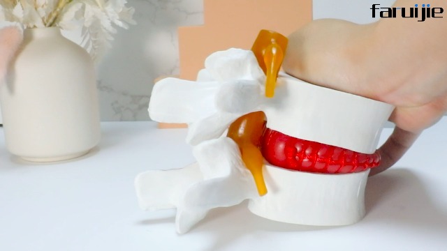 Image of Disc Herniation Model - 1.5X Lumbar Herniated Disc Model Vertebral Spine Anatomical Medical Model