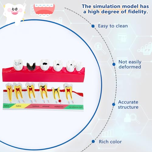 Image of Dental Caries Progression Model,6-Stage Tooth Decay Classification Model for Dental Education,Dental Training,Demonstrations,Oral Care Educatio