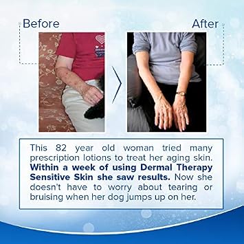 Dermal Therapy Sensitive Skin Lotion - Calming, Non-Irritating Lotion with 15% Allantoin, 10% Shea Butter, Vitamin E - Soothing Relief for Dry, Itchy, Eczema-Prone Skin - 8 fl oz / 240 ml