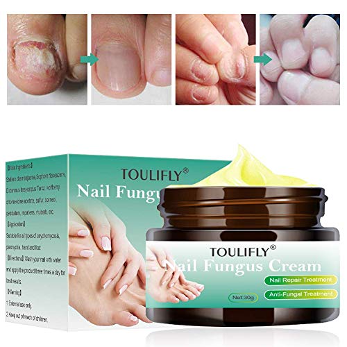 Nail Fungus Cream,Toenail Fungus Treatment,Nail Fungus Remover,Toenail Fingernail Fungus Remover Fungus Stop Cream