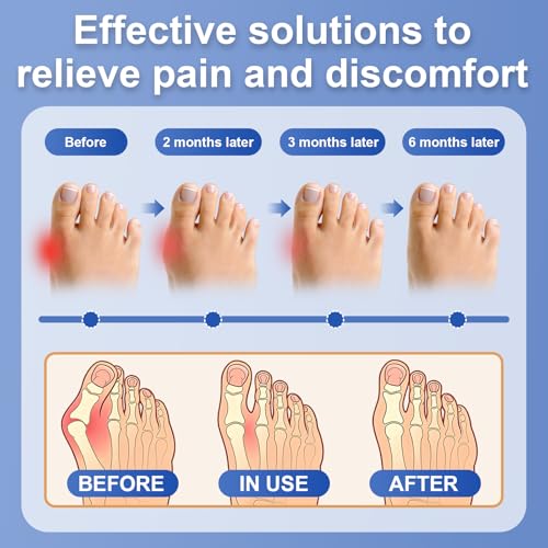 Charmchic 2 Pezzi Correttore Alluce Valgo Donna, Tutore Alluce Valgo Con Divaricatore Dita Piedi, Protezione Alluce Valgo Sottile E Traspirante, Lavabile Riutilizzabile (L, Nude) - 5