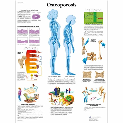 Image of 3B Scientific VR3121L Glossy UV Resistant Laminated Paper Osteoporosis Anatomical Chart (Osteoporosis Anatomical Chart, Spanish), Poster Size 20 inch Width x 26 inch Height