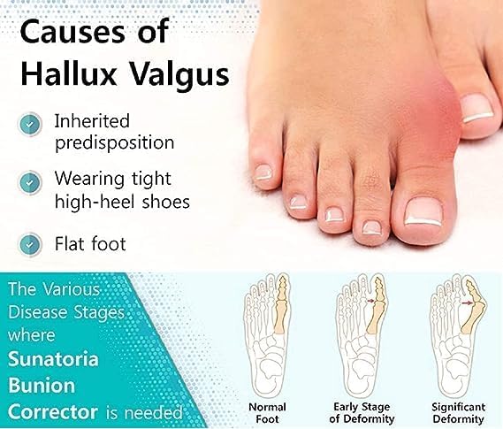 Feinerman 2 Pcs High Elastic Silicone Gel Toe Separators, 5 Holes Toe Straightener for Hammer Toe, Hallux Valgus Corrector, Bunion Relief, Toe Spacers, and Achilles Stretcher for Foot Pain 3