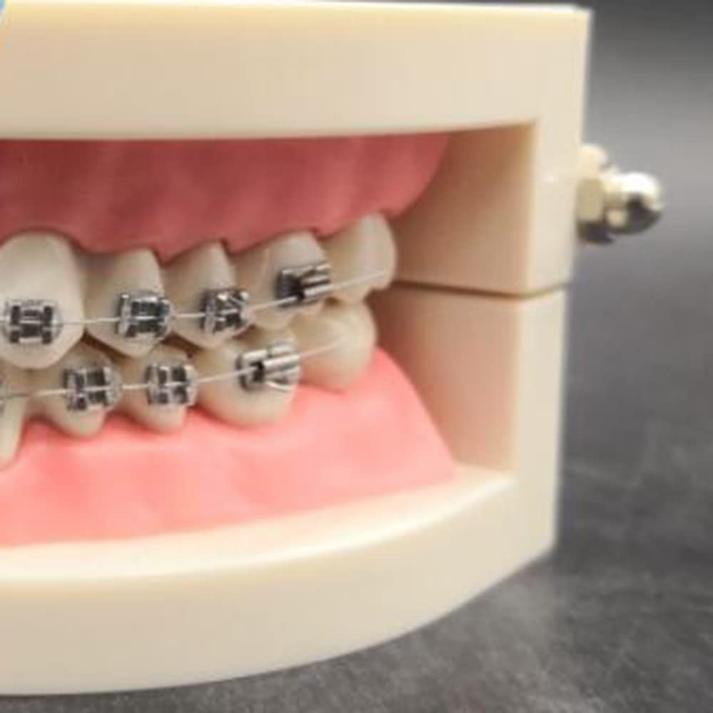 Modello di Simulazione dei Denti orali - Modello dimostrativo ortodontico Dentale - Modello di Trattamento dei Denti dentali con Attacco Metallico, Modello esplicativo dell'ar,B