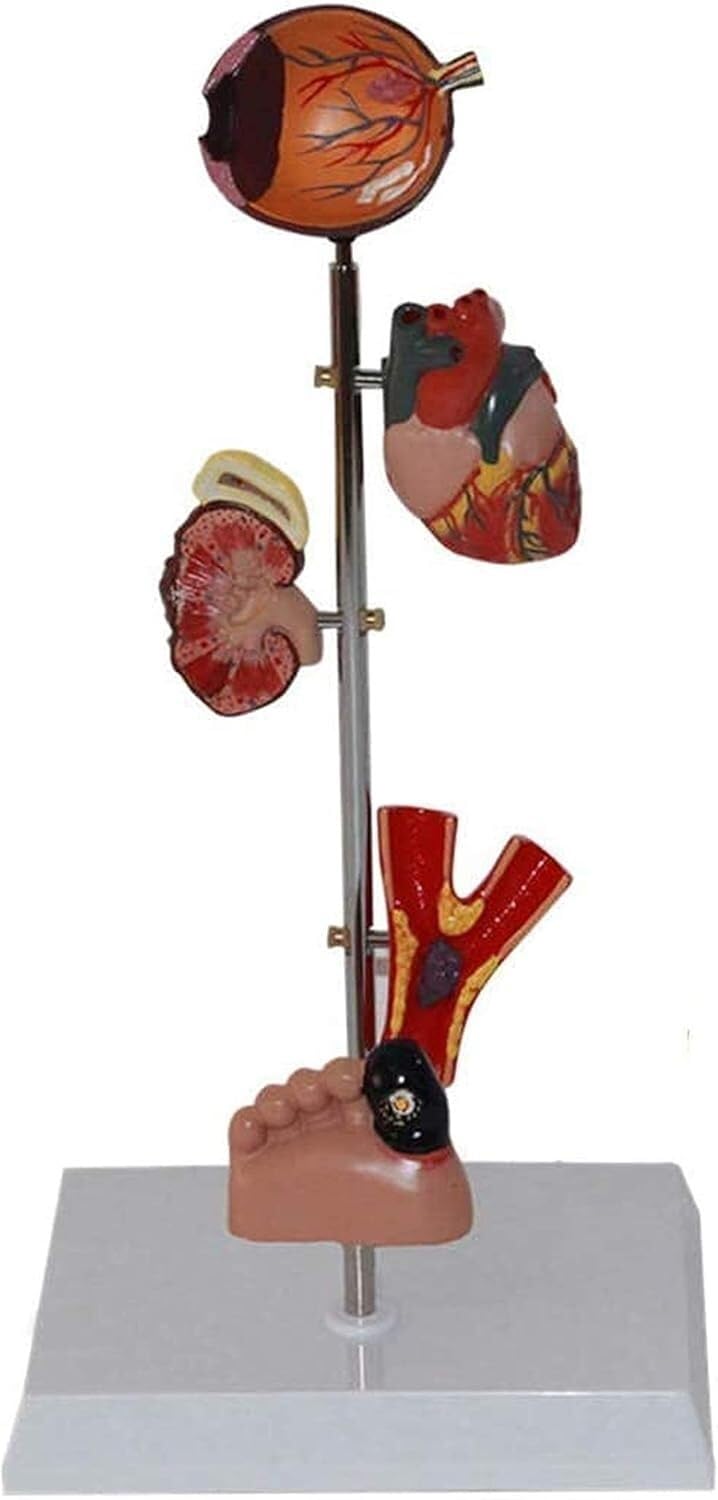 Modèle d'organe du diabète - Modèle d'anatomie médicale Modèle de diabète - Modèle Scientifique d'anatomie Humaine Amovible - for l'éducation et la Formation médicales