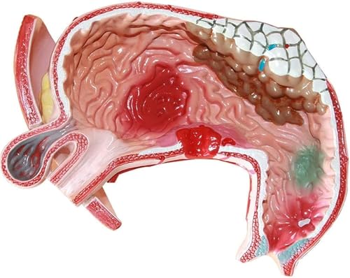 Modèles médicaux d'ulcère gastrique pour simplifier les diagnostics - 4
