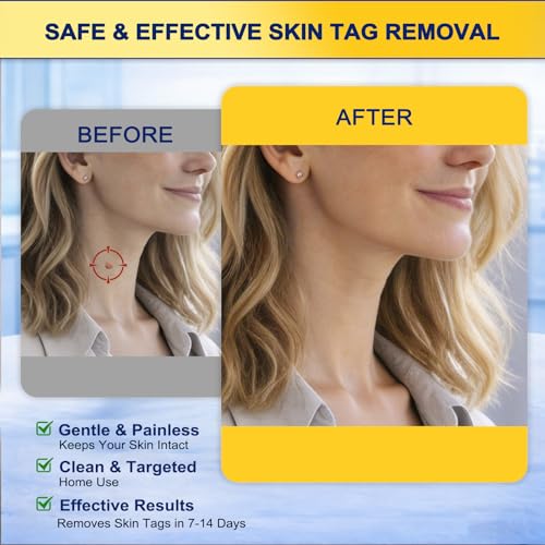 Skin Tag Removal Kit For Home Use, Featuring Precise And Controlled Pain-Free Application, Easy To Use Even For First-Time Users, Removes Skin Tags In 7–14 Days, Everyday Comfort And Confidence, 30 Ml - 4
