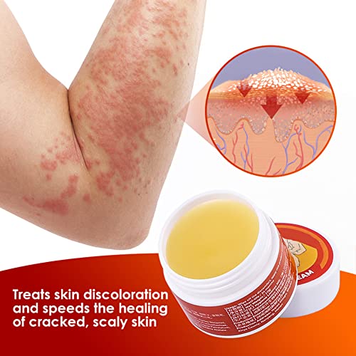 Ysgbysg Skinmedix Psoriasis Herbal Treatment Cream, Skinmedix Psoriasis Cream, Natural Chinese Herbal Cream, Anti-Itch Cream Ointment For Face And Body (5Pcs) #TOP5