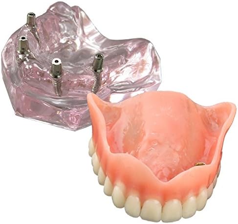 Dental Model Overdenture Upper Teeth 4 Implants Demo for Teaching and Studying