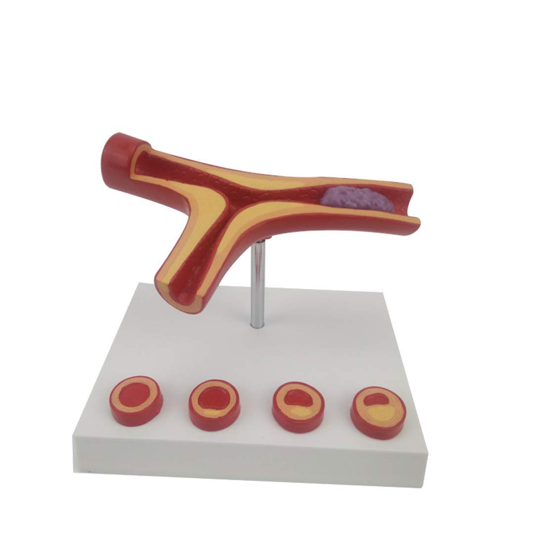 Buy Educational Model Arteriosclerosis Model Arterial Cardiac Blood