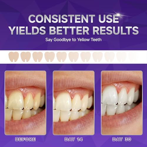 LKMC Purple Teeth Whitening Strips (60 Strips/30 Treatments) Professional Whitening Strips, Removes Coffee & Wine Stains, Enamel Safe & Low Sensitivity, Non-Slip Residue-Free - Image 2