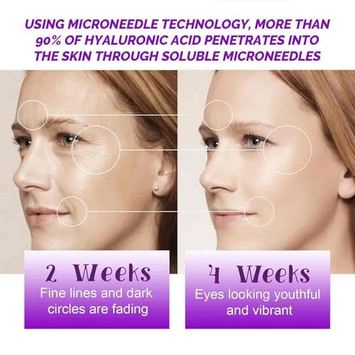 Serum-Infused Micro Dart Patches, Dissolving Microneedle Under Eye Patches With 39% Hyaluronic Acid,