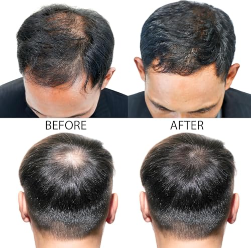 Hair-Regen Tratamento Avançado de Crescimento Capilar com Minoxidil 5% - 1 mês Tratamento, para Qued