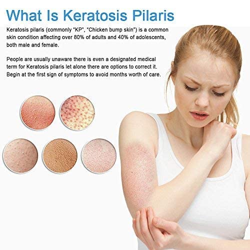KP Essentials Keratosis Pilaris Exfoliating Cream Clear Red Bumps