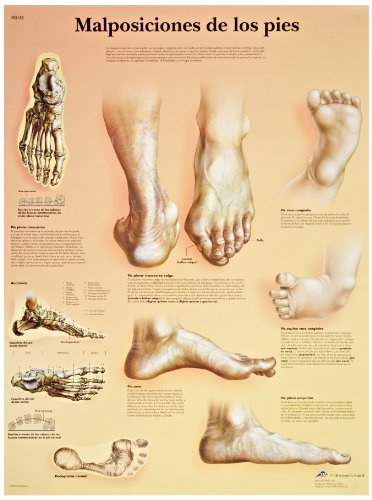 Image of 3B Scientific VR3185UU Glossy Paper Malposiciones De Los Pies Anatomical Chart (Deformities of The Feet Anatomical Chart, Spanish), Poster Size 20 inch Width x 26 inch Height