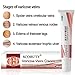 Varicose Veins Cream, Varicose Vein Treatment, Vein Cream for Spider Veins, Relief Phlebitis Angiitis Inflammation Blood Vein Veins Vasculitis Treatment Legs, Herbal Care Ointment Relief Phlebitis