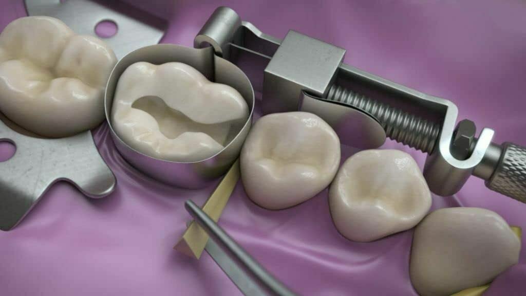 Tofflemire Retainer 8/105 pour les interventions dentaires