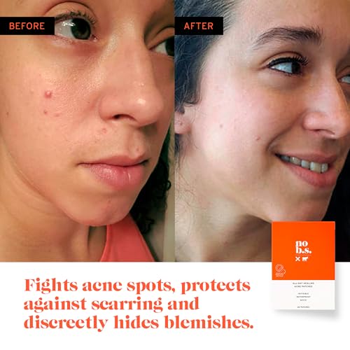 No BS Healing Acne Patches - Hydrocolloid, Acne Spot and Pimple Treatment to Prevent Acne Scars. Invisible On All Skin Tones (1 BOX of 36ct). Includes Free Skincare Samples