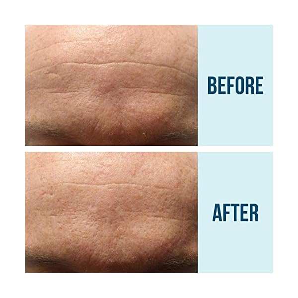 SiO Beauty For Him BrowLift | Forehead Anti-Wrinkle Patch | Overnight Smoothing Silicone Patches For Forehead Furrows, Expression Lines And Creases