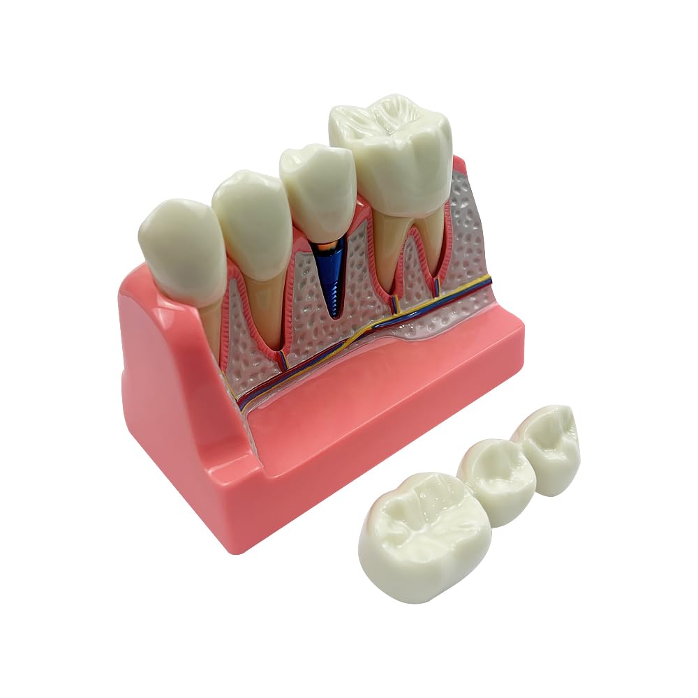 SENLIN DENTAL 4 Times Dental Implant Model, Removable Teeth Model, Dental Implant, Crown and Bridge Model for Demonstration of Tooth Structure