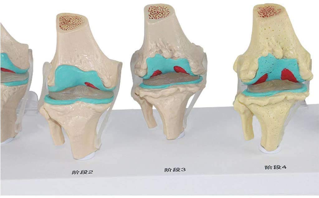 Modèle de blessure au Genou en 6 étapes - Le Genou modèle Anatomique Joint - Affichage de la Science de l'étude en Classe avec des modèles de Rubans et de matériel médical