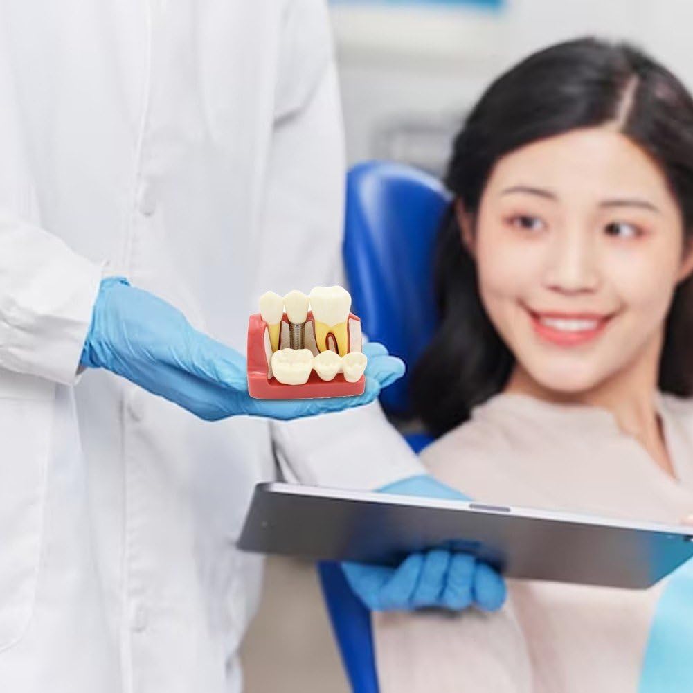 Modello di Impianto Dentale 4 Volte Modello di Denti Dimostrativo Ingrandito Modello di Denti Didattici Modello di Analisi Rimovibile Ponte della per Studente di Odontoiatria