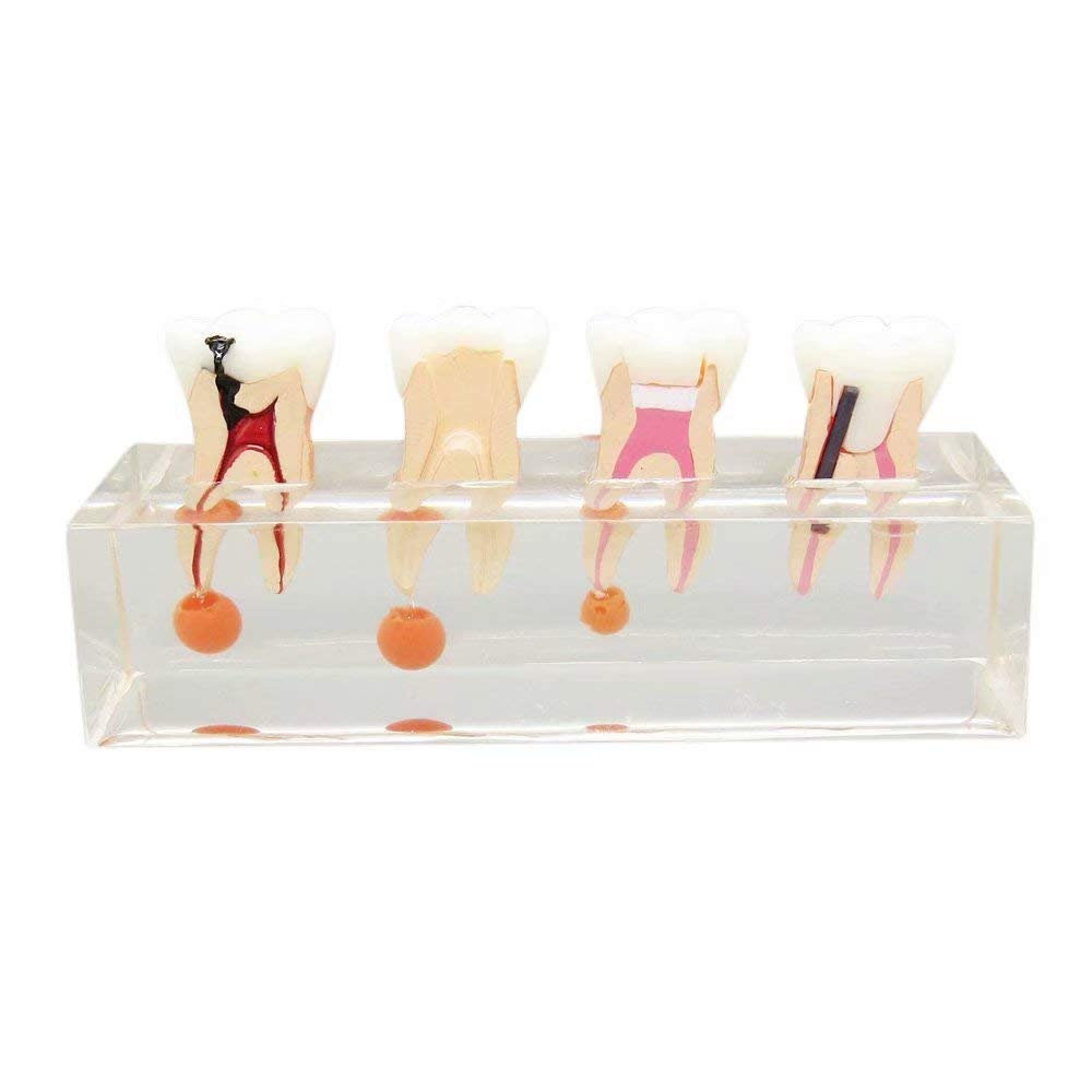 4-Stage Endodontic Treatment Model for Studing Teaching Teeth Model #4003