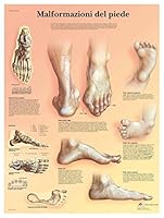 3B Scientific Lehrtaffel laminiert - Malformazioni di piede - Italienisch