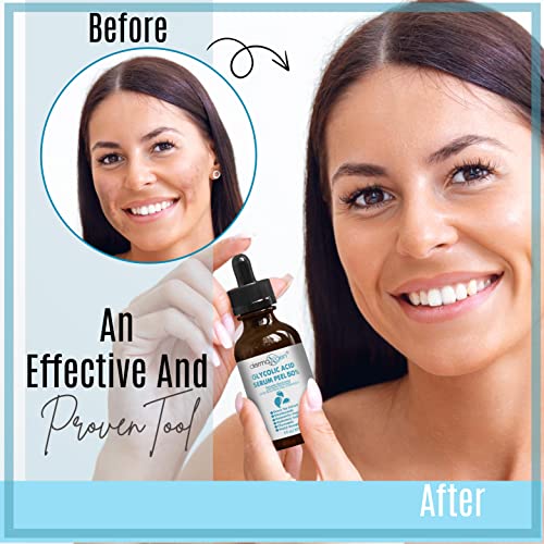 Dermaxgen Glycolic Acid 50% Professional Grade Resurfacing Serum Pure Organic Chamomile + Green Tea Extracts + Hyaluronic Acid For Wrinkles, Fine Lines, Smooth & Fade Scars, Hyperpigmentation (1 Fl Oz) #TOP5