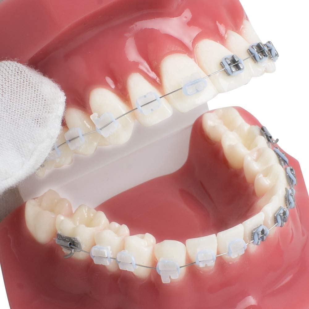 Modello di Organo Modello di Ortodonzia Dentale con Supporti in Metallo E Ceramica Orale Dimostrazione per Il Dentista per Comunicare con I Pazienti