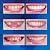ZNXY 4 Pairs Top and Bottom Denture Fake Teeth Veneer Dental,Veneers Snap in Teeth,Cosmetic Tooth Replacement Kit for Real Teeth, Top Only One Size Fits Most