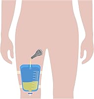 Vista 3 de Kit completo urinario 5 días 5 catéteres de condón externos auto-marino + bolsa para piernas de 25.4 fl oz + correas con un tubo de 5.9 pulgadas 5.9