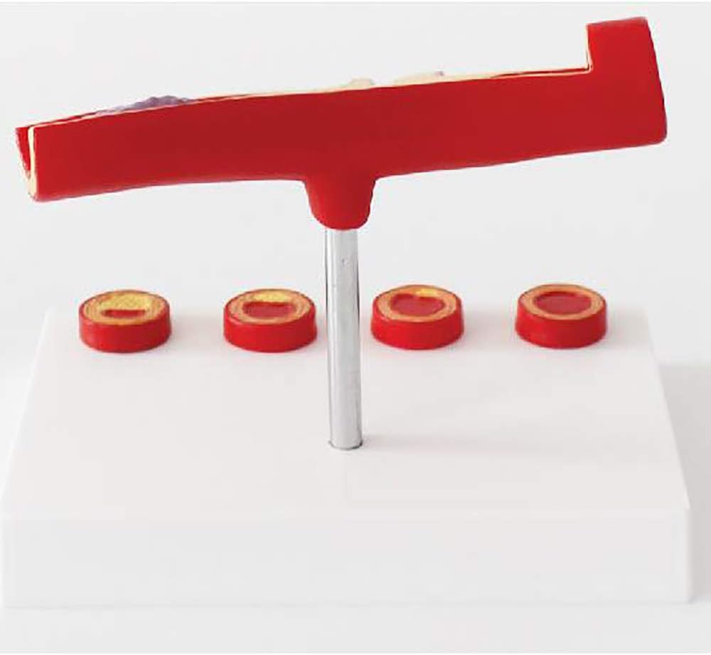 Teaching Model,Human Blood Vessel Anatomical Model, Human Y-Vessel Model Cardiovascular Atherosclerosis Model, Thbosis Demonstration, Arteriosclerosis Model