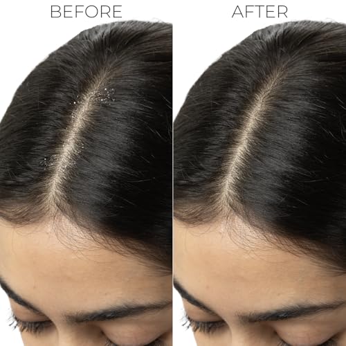 Image of Professional Dandruff Control Shampoo | Anti Dandruff Shampoo for Women & Men | Shampoo for Dandruff & Itchy Scalp Relief | Reduces Flakes from 1st Wash | 300 ml