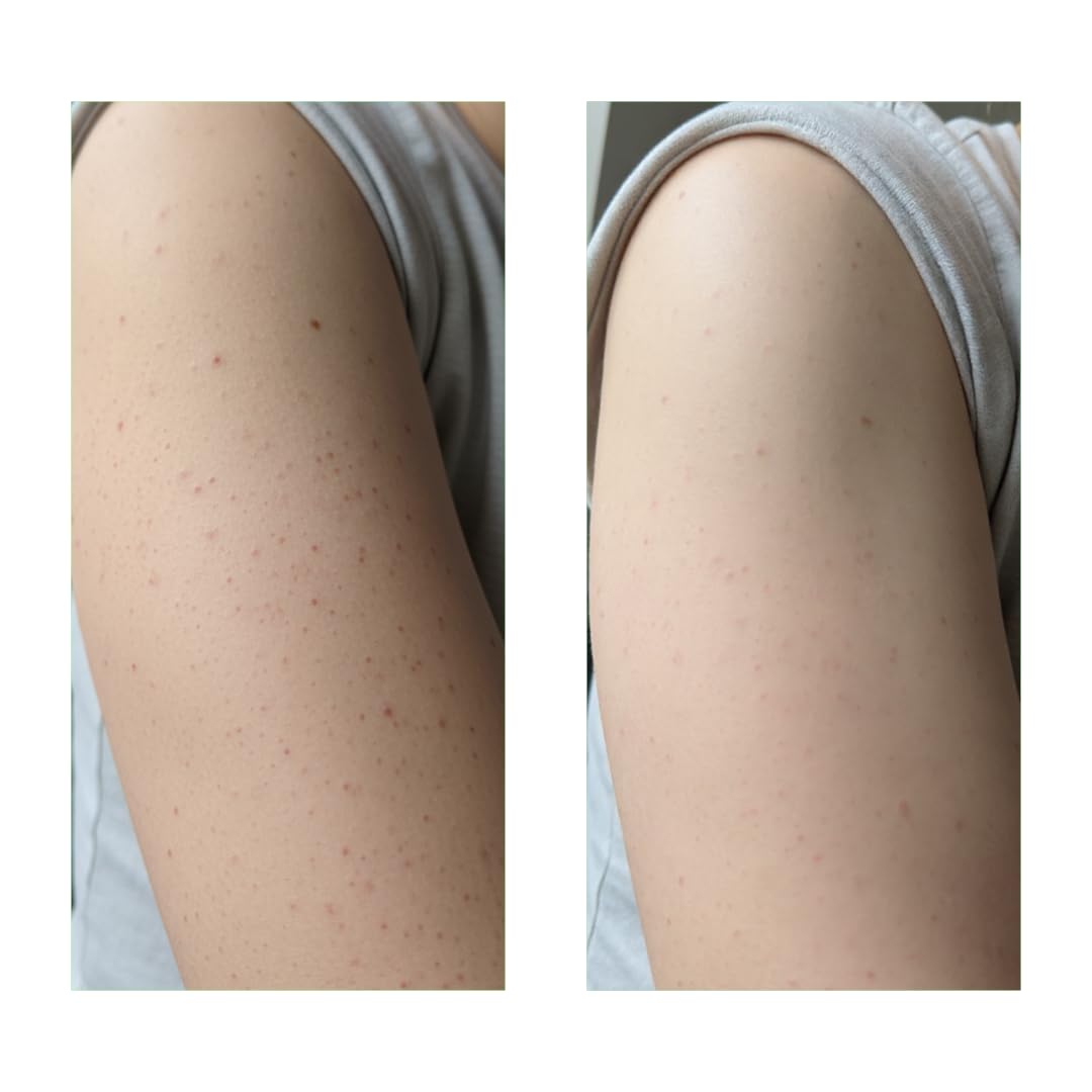 Keratosis Pilaris Set gegen Erdbeerhaut Anti Reibeisenhaut Bundle