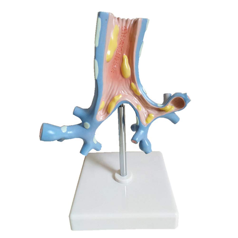 Buy The Bronchial Pathology Model—Shows the Common Bronchial Lesions ...