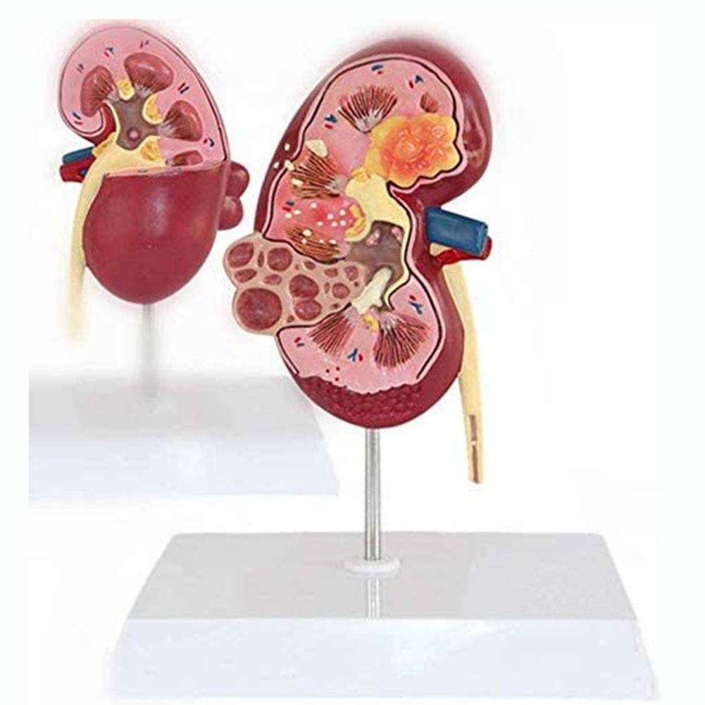 Sjdopulse Life Size Human Kidney Diseased Model Pathological Stone Organ For Doctors Office Educationa Tool Anatomicals