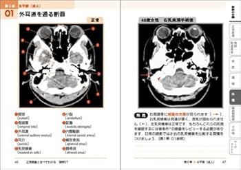 正常画像と並べてわかる頭部CT (ここが読影のポイント) | 藤原
