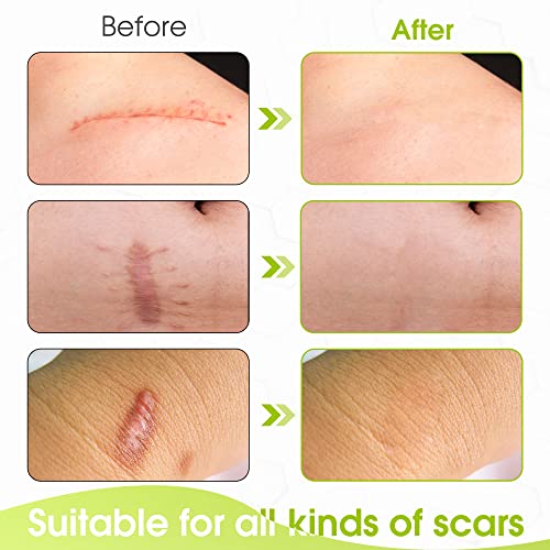 Professional Silicone Scar Sheets,Silicone Scar Tape Roll (1.6” x 120