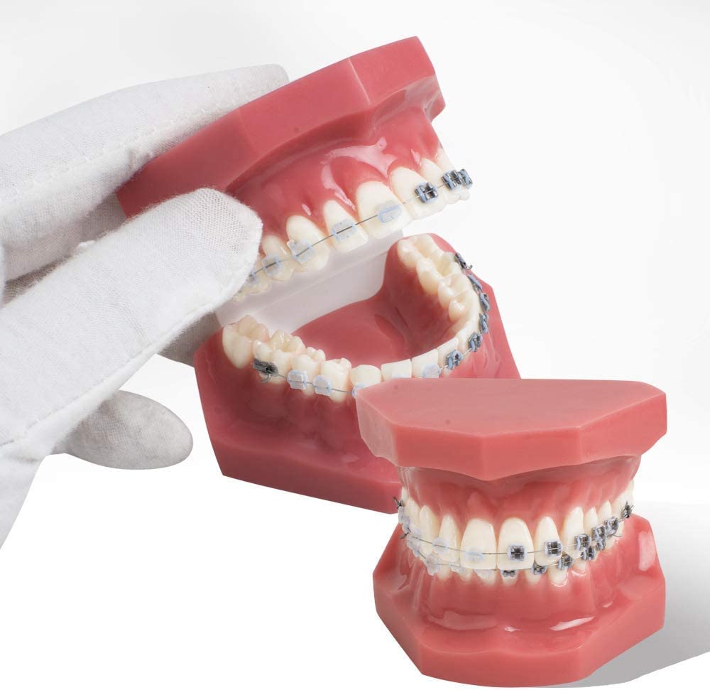 Modello Ortodontico Dentale Modello di Denti con Attacchi in Metallo E Ceramica Modelli Dimostrativi Orali per L'Insegnamento Odontoiatrico O per La Comunicazio