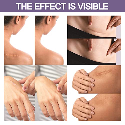 Narbenpflaster, Narbenpflaster Nach Op, Silikonpflaster für Narben, Silikon Narbenpflaster, Selbstklebende Narbenrolle… - Image 7