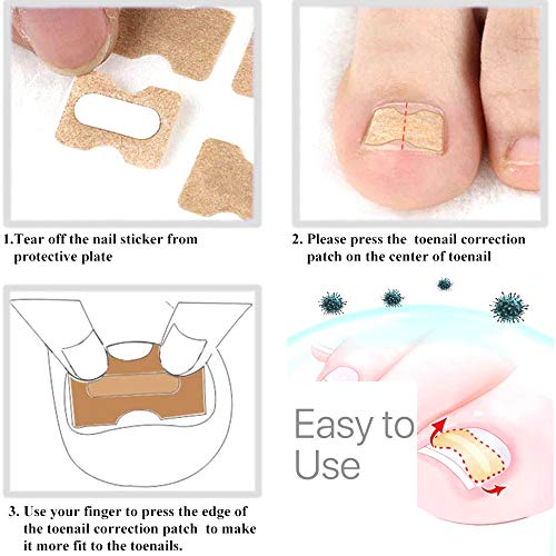 Juego de 5 parches de uñas sin pegamento – Kit de herramientas encarnadas para uñas de los pies para tratamiento de uñas, herramienta de corrección de uñas encarnadas para eliminar las uñas de los pies remiendo profesional para mantener las uñas saludable 8
