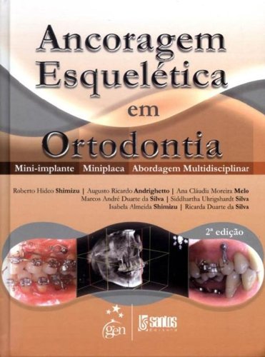 Ancoragem Esquelética em Ortodontia - Mini-implante - Miniplaca - Abordagem Multidisciplinar